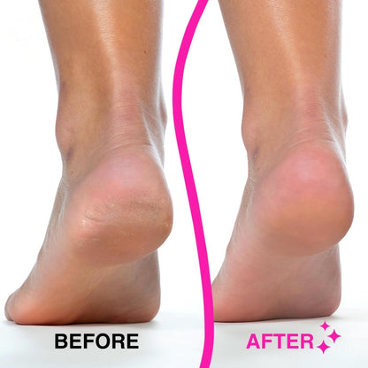 Vanuca™ Silk Pro Electric Callus Remover